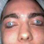 Eyelid Tattoo - Shocking Pic