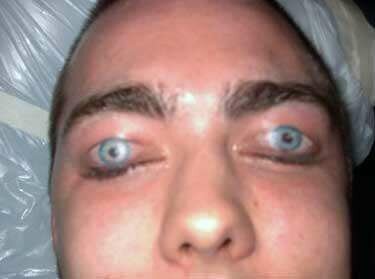 Eyelid Tattoo - Shocking Pic
