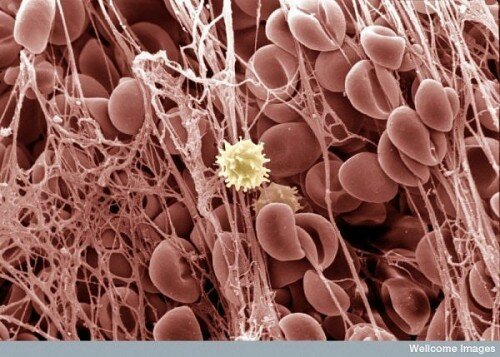 Human Body Microscopic Picture - Blood Clot with White Blood Cell
